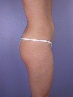 Liposuction Before and after photo