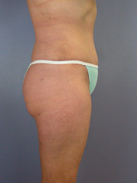 Liposuction before and after photo