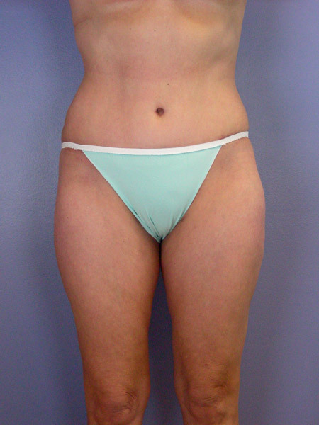 Liposuction before and after photo