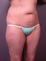 Liposuction Before and after photo