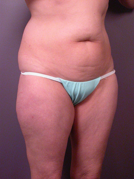 Liposuction before and after photo