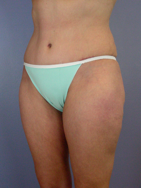 Liposuction before and after photo