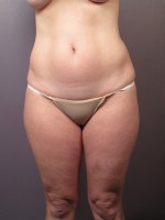Liposuction