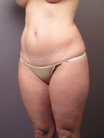Liposuction