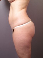 Liposuction Before and after photo
