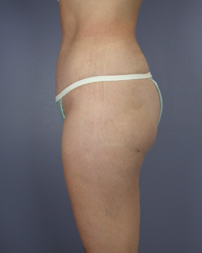 Liposuction before and after photo