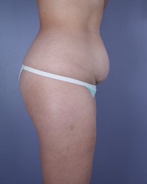 Liposuction before and after photo