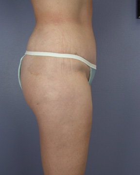 Liposuction before and after photo