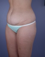 Liposuction Before and after photo