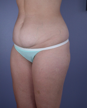 Liposuction before and after photo