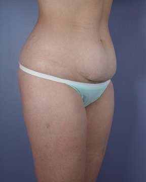 Liposuction before and after photo