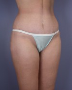 Liposuction Before and after photo
