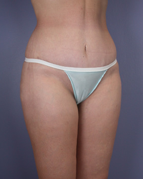 Liposuction before and after photo