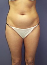 Liposuction