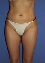 Liposuction