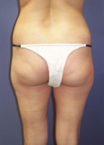Liposuction