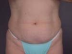 Liposuction Before and after photo