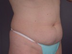 Liposuction Before and after photo