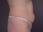 Liposuction Before and after photo