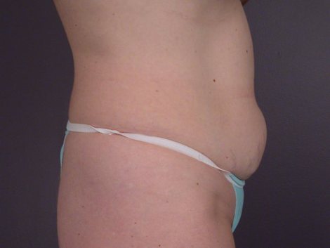 Liposuction before and after photo