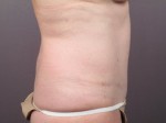 Liposuction Before and after photo