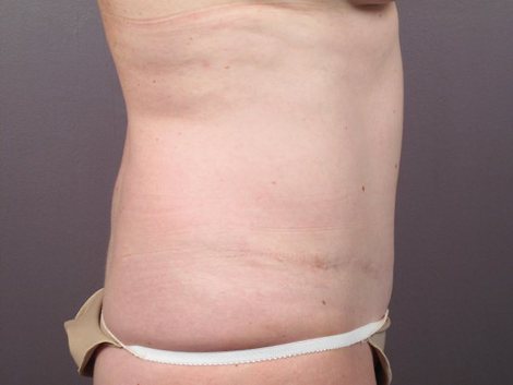 Liposuction before and after photo