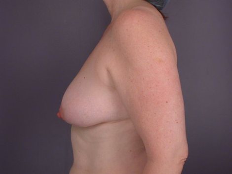 Liposuction before and after photo