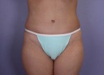 Liposuction Before and after photo