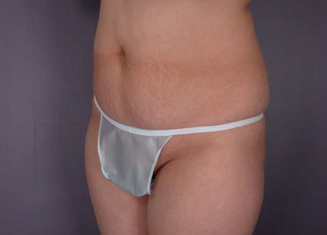 Liposuction before and after photo