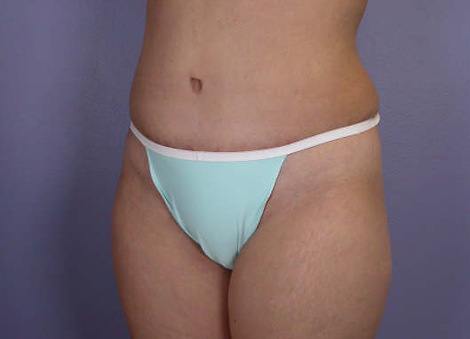 Liposuction before and after photo