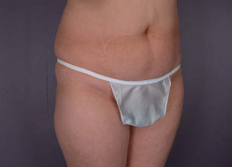 Liposuction before and after photo