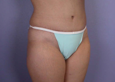 Liposuction before and after photo