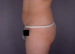 Liposuction Before and after photo