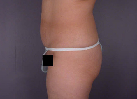 Liposuction before and after photo