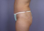 Liposuction Before and after photo