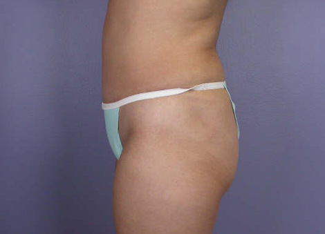 Liposuction before and after photo