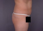 Liposuction Before and after photo