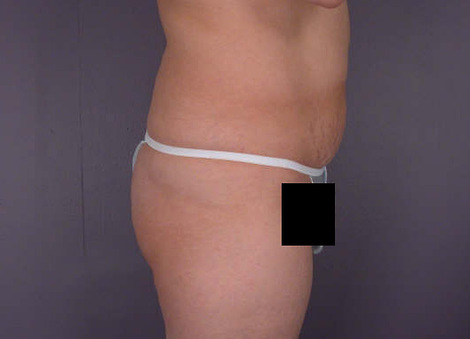 Liposuction before and after photo