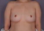 Liposuction Before and after photo