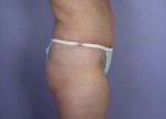 Liposuction Before and after photo