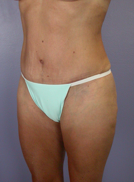 Liposuction before and after photo