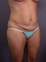 Liposuction Before and after photo