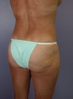 Liposuction Before and after photo