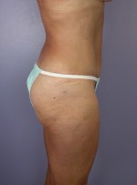 Liposuction Before and after photo