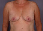 Liposuction Before and after photo