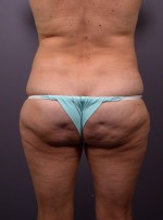 Liposuction Before and after photo