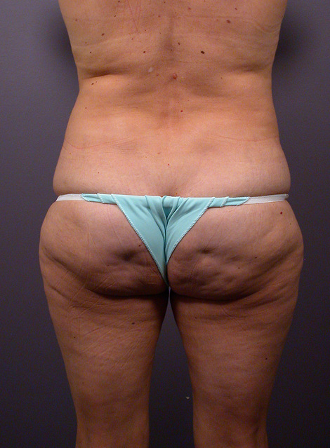 Liposuction before and after photo