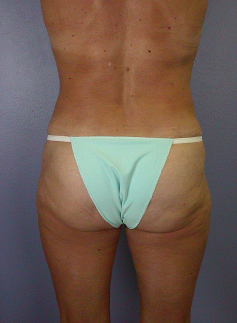 Liposuction before and after photo