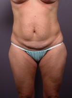 Liposuction Before and after photo