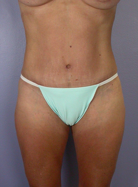 Liposuction before and after photo